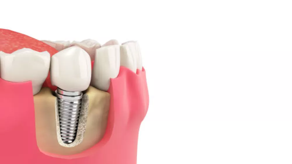Cuanto vale implantarte dientes en toda la boca en Chamberí